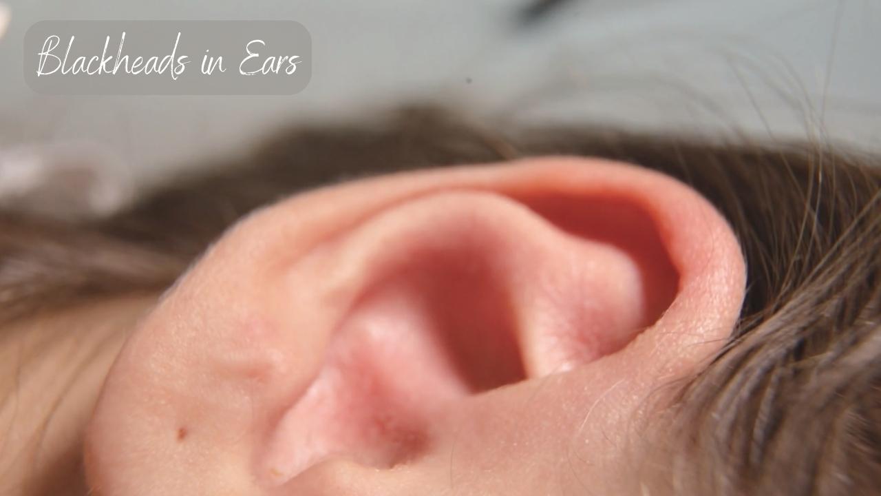 How To Get Rid of Blackheads in Ears - Clear Skin Secrets - Aceb