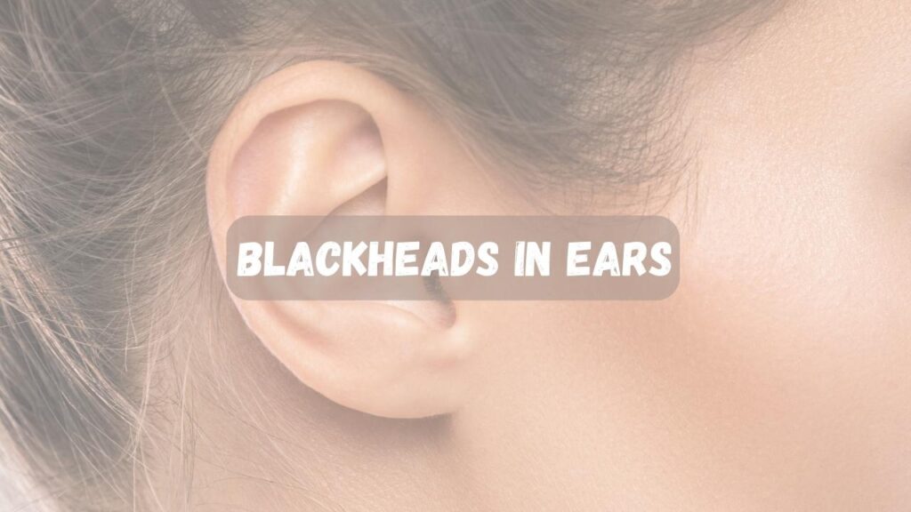 How To Get Rid of Blackheads in Ears Clear Skin Secrets Aceb