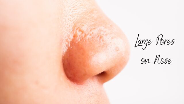 Large Pores on Nose, Big, Enlarged – How to Get Rid, Treat or Shrink
